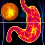 tumor-index-predicts-stage-i-gastric-cancer-recurrence