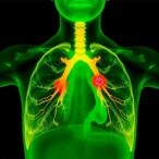 hyperthermia-linked-to-reduced-radiation-pneumonitis