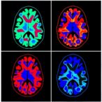 merging-imaging-and-omics-to-refine-mci-subtyping