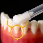 ellagic-acid-shields-tooth-adhesives-post-bleaching