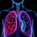 evaluating-immunotherapy-response-in-lung-cancer-patients