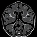 mr-urography-assesses-pediatric-upj-obstruction-treatment