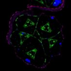 rb-loss-boosts-triple-negative-breast-cancer-stress-apoptosis