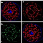 foxd3-as1-targeting-slows-prostate-cancer-progression