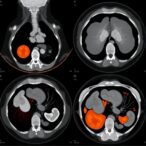 thalassemia-patient-shows-brown-tumors-via-pet/ct