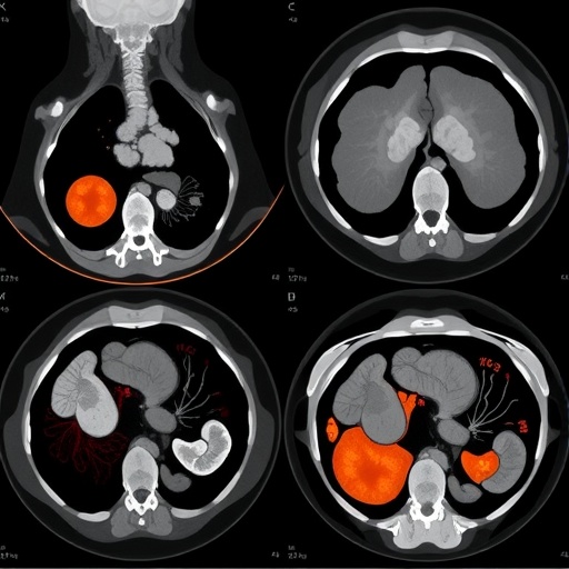 thalassemia-patient-shows-brown-tumors-via-pet/ct