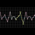 continuous-electrocardiographic-index-reveals-sex-differences