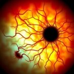 anti-ceramide-immunotherapy-treats-diabetic-retinopathy