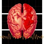 low-heart-rate-variability-signals-severe-brain-bleeds