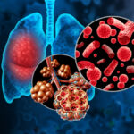 enzyme-linked-to-fatal-heart-conditions-with-pneumonia-infections-identified
