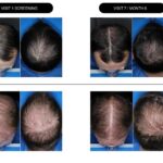 stockwatch:-cosmo-surges-40%-on-baldness-candidate’s-phase-iii-data