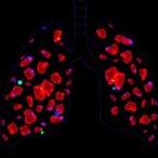 il-1β+-lung-macrophages-drive-sepsis-lung-injury