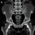 directional-asymmetry-in-acetabulum:-age-estimation-insights
