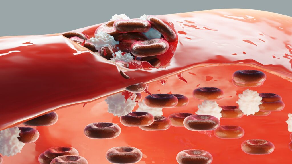 new-monoclonal-antibody-shows-promise-in-immune-thrombocytopenia