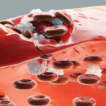 new-monoclonal-antibody-shows-promise-in-immune-thrombocytopenia