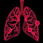genomic-and-transcriptomic-changes-drive-lung-adenocarcinoma-progression