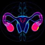 ai-model-predicts-recurrence-in-ovarian-tumors