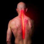 high-dose-risankizumab-shows-promise-for-severe-psoriasis
