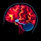 creatine-weighted-imaging-reveals-insights-in-parkinson’s-disease