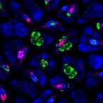 disruption-of-cd248-in-melanoma-limits-metastasis