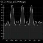 nomogram-predicts-low-voltage-in-atrial-fibrillation