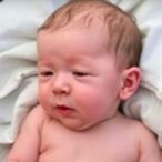 dandy-walker-syndrome:-multiple-associated-congenital-anomalies