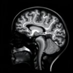 advancing-neonatal-brain-prognosis-with-diffusion-kurtosis