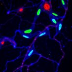 sult2b1-drives-emt-in-biliary-atresia-via-wnt-pathway