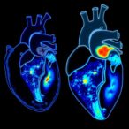 ai-driven-spot-imaging-enhances-myocardial-scar-detection
