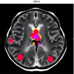 unraveling-mri-signatures-in-breast-cancer-prognosis