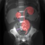 spot-urine-ca-19-9:-new-insights-in-pediatric-hydronephrosis