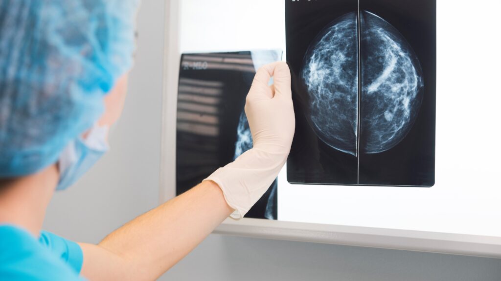 hologic-breast-cancer-study-bolsters-use-of-mammogram-ai