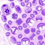 mmp-7-and-serological-markers:-diagnosing-liver-fibrosis