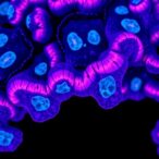 transformative-histology-impacting-egfr/alk-nsclc-treatments