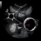 decoding-pediatric-lymphadenopathy:-ultrasound-insights-and-challenges