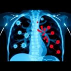 child’s-necrotizing-pneumonia:-influenza-a-and-staph-co-infection
