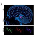 gendered-immune-responses-influence-parkinson’s-disease-progression