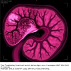 pancreatic-acinar-carcinoma-shows-kras-wild-type-similarities