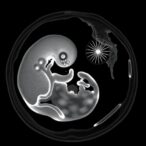 first-use-of-0.31t-mri-in-fetal-autopsy
