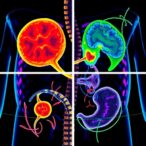 ai-models-enhance-prognosis-and-immunotherapy-in-gastric-cancer