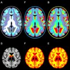 hybrid-transfer-learning-enhances-brain-tumor-detection