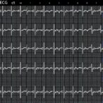 ecg-findings-in-children-with-sickle-cell-anemia