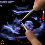 ultrasound-reveals-pain-responses-to-needle-depth