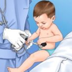 assessing-day-case-laparoscopic-suturing-for-pediatric-hernias