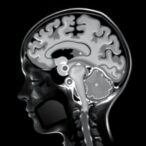 unreported-link:-hemiplegia-and-leukodystrophy-in-children