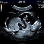 ultrasound-gallbladder-disease-diagnosis-enhanced-by-ai