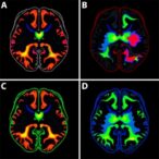 targeting-gasdermin-d-in-tau-related-frontotemporal-dementia