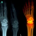 neonatal-candida-osteomyelitis-and-septic-arthritis-case-study