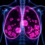 pirfenidone-and-paclitaxel-diminish-triple-negative-breast-cancer