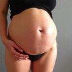 undetected-uterine-torsion-linked-to-adenomyosis-in-pregnancy